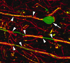 Fig. 3. Multiple sclerosis strips axons of myelin and severs neurons. Axons (green) are normally myelinated (red). During multiple sclerosis, axons lose myelin (arrowheads) and can break as a result (arrow).