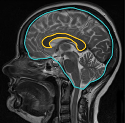 Midsagittal view of a patient’s brain with the corpus callosum and the intracranial skull surface area outlined. Credit: Granberg <em>et al.</em>, <em>Multiple Sclerosis Journal</em> DOI: 10.1177/1352458514560928 © 2014 by the authors. Reprinted by permission of SAGE.