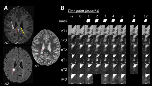 Time-lapse images of lesion evolution in a woman with RRMS. Lesions appeared 2 months before time zero and are indicated by the arrows in image A1. From Reich <em>et al.</em>, 2015.