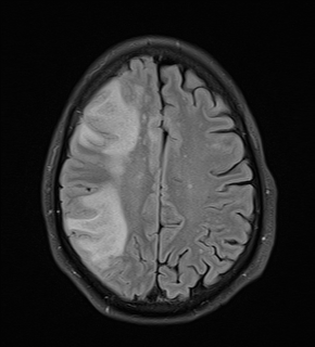This MRI image of a person with natalizumab-associated PML shows a large lesion in the right hemisphere of the brain. PML kills myelinmaking oligodendrocytes and other brain cells, destroying white matter. The JC virus can also infect and damage gray matter, causing other destructive acute diseases. Image courtesy of Dr. A. Valavanis, Dept. of Neuroradiology, University Hospital Zurich.