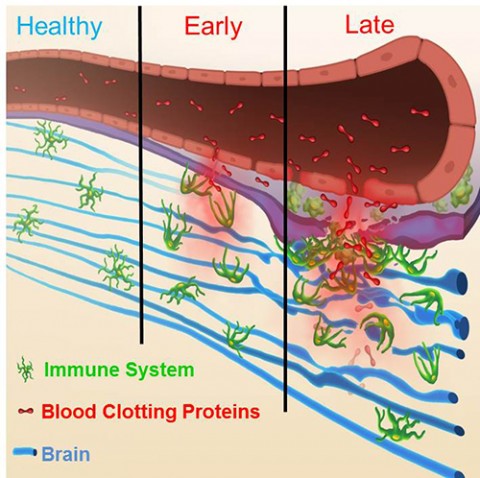 Blood vessels become leaky in early MS (middle) and leakier still in late MS (right). Credit: Katerina Akassoglou, Ph.D.