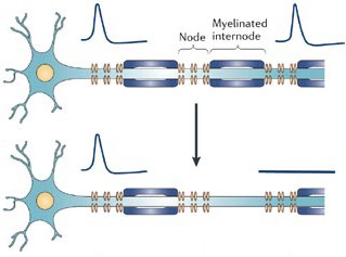 Fig. 4. Without myelin, axons transmit information slowly, inefficiently. Normally, action potentials hop over myelinated regions in a process known as saltatory conduction. When myelin breaks down, action potentials move slowly through these regions rather than hop over them. In addition, a lack of myelin leads to leakage of ions across the membrane and signal interference between neighboring axons.