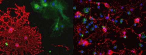 B-cell-secreted factors from RRMS patients injure oligodendrocytes in vitro. Cultured oligodendrocytes (red) reach out and touch each other, forming thin membrane sheets. Scientists added B-cell medium from healthy controls (left) and from RRMS patients (right). B-cell-secreted factors from RRMS patients fragmented the oligodendrocyte sheets and shrunk cell bodies, leaving behind the remnants of bare nuclei (blue). 