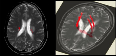 Fig. 2. Reconstruction of the corticospinal (motor) tract through an MS lesion. Diffusion tensor imaging, or DTI, can show where MS lesions interact with functionally important neural pathways. In this case, a lesion (fuzzy white spot, right side of the images) disrupted the motor tract (red), a group of axons that pass downward from the motor cortex, of an individual with MS. The patient was paralyzed on one side, but eventually recovered.