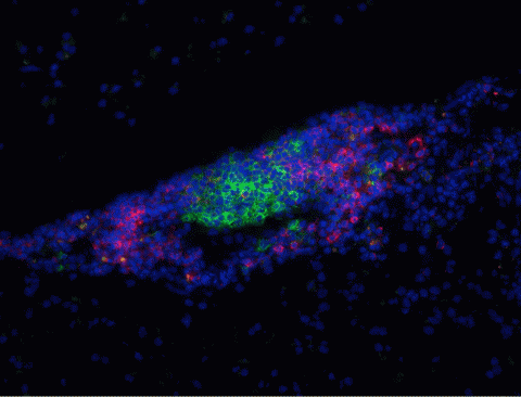 B-cell follicle-like structure in post-mortem brain. B cells, stained with a monoclonal antibody specific for the B-cell marker CD20 (green) are surrounded by other lymphocytes, many of which are CD8+ cytotoxic T cells (red). Cell nuclei are stained with DAPI (blue). The sample is from a patient with secondary progressive multiple sclerosis and was obtained from the UK MS Tissue Bank at Imperial College London. 