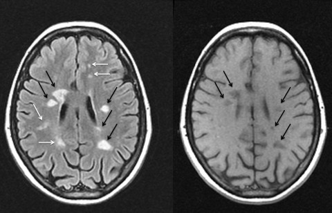 Fig. 1. Bright spots represent lesions on a T2 FLAIR (fluid-attenuated inversion recovery imaging) scan—a type of conventional T2-weighted image (left)—of an MS patient’s brain. Only those lesions marked by black arrows show up as persistent “black holes” or hypointensities on a T1 image (right), indicating a more severe degree of tissue destruction within them.