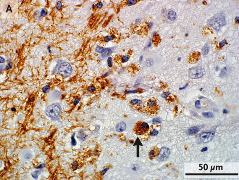 Fig. 2. Multiple sclerosis plagues gray matter too. Because white matter is replete with myelin, damage associated with multiple sclerosis was first discovered in white matter. But gray matter—such as the cerebral cortex—also suffers in multiple sclerosis. Evidence of inflammation, such as the presence of macrophages (arrow) and T cells, is present in this brain region.