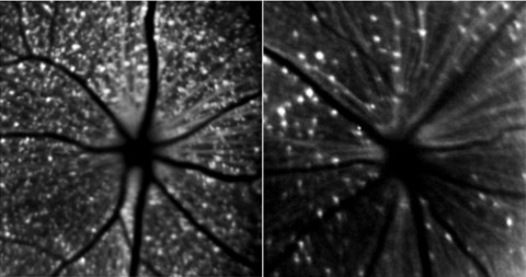Confocal scanning laser ophthalmoscope imaging during optic neuritis in MOG<sup>TCR</sup>x<em>Thy1</em>CFP mice. At left is an example of the retina before disease induction, and at right is the retina 21 days following disease induction. From Lidster <em>et al</em>., 2013.