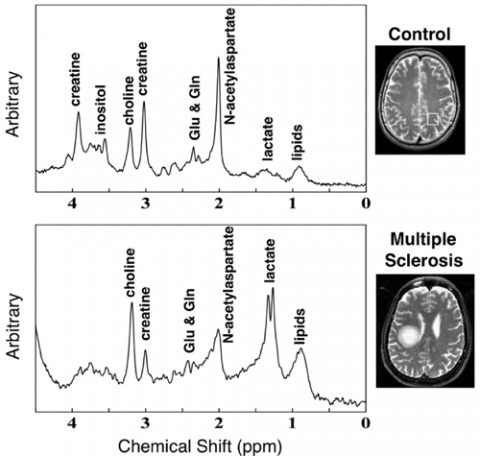 Investigators observed pronounced increases of choline and lactate in a person with MS compared to a healthy subject using <sup>1</sup>H-MR spectra (TR/TE = 3000/30 ms). Credit: Mori, Y. <em>et al</em>., <em>International Immunology</em>, doi:10.1093/intimm/dxt044, 2013 by permission of the Japanese Society for Immunology.