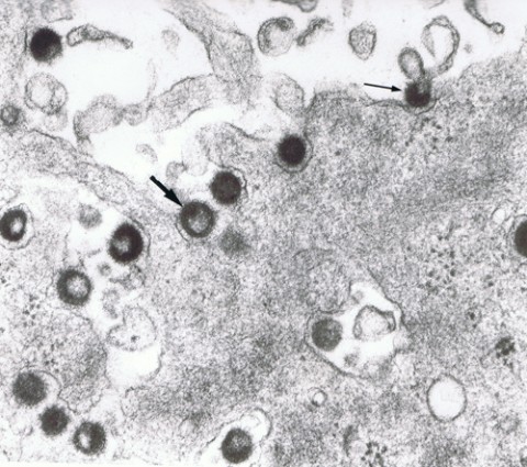This electron microscopy image shows HERV-W viruses (also called MSRV in the form of an active virus particle) budding off from leptomeningeal cells that normally surround the brain and spinal cord, derived from the spinal fluid of MS patients. Two of the dark, round virus particles are marked with an arrow. Image courtesy of Hervé Perron.