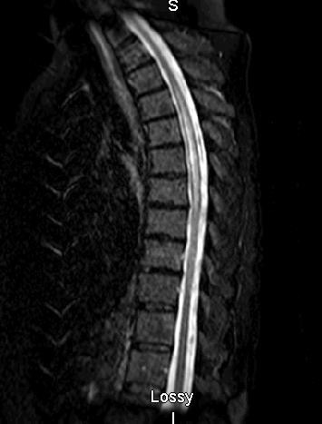 Longitudinal extensive spinal cord lesion (transverse myelitis) that affects several segments of the spinal cord in an NMO patient. Credit: Jeffrey Bennett, University of Colorado, Denver