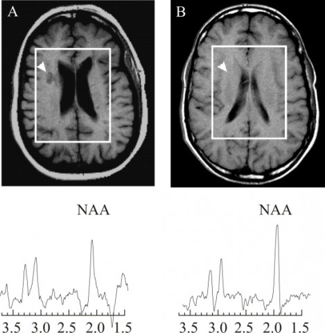 Proton MR spectra from a 28-year-old female patient with MS. The N-acetylaspartate (NAA) peak is lower in the lesion (A) than in a region of normal-appearing white matter (B) indicating neuro/axonal loss and dysfunction in the lesion.