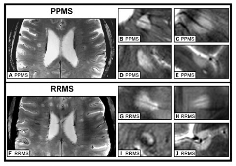 Under 7-tesla MRI, brain lesions of a PPMS patient (panels A through E) closely resemble the lesions from an RRMS patient (panels F through J). In both patients, lesions surround blood vessels (panels B, C, G, and H) and show a dark, hypointense rim (panels D and I). Credit: Friedemann Paul.