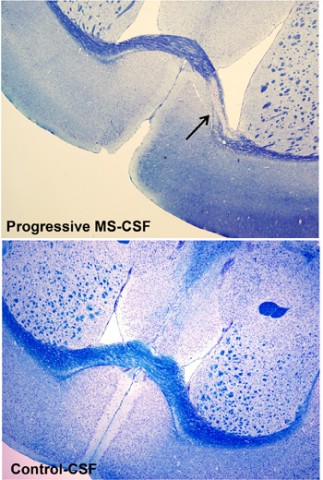 A comparison between brain sections derived from mice injected with CSF from either healthy people or those with progressive MS. A myelin stain reveals an extensive lesion in the corpus callosum of the mouse in the experimental group. Credit: Massimiliano Cristofanilli, Tisch MS Research Center