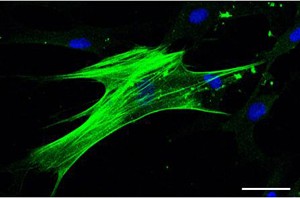 Mesenchymal stem cell from an MS patient donor. The green stain illuminates the smooth muscle isoform of alpha actin. Scale bar is 50 μm. Credit: Violaine K. Harris, Ph.D.