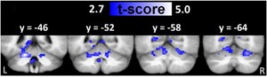 Coronal t-maps representing voxels with reduced regional homogeneity in MS compared with controls. Image credit: Dogonowski et al. PMID: 24371795]