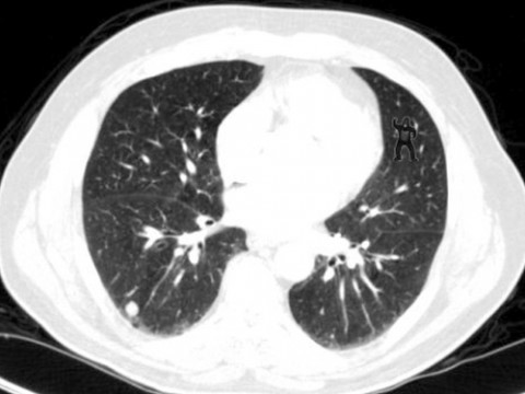 Told to look for cancerous nodules, 83% of radiologists failed to notice the gorilla in the upper right. Image credit: Trafton Drew and Jeremy Wolfe.