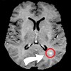 MS brain lesion
