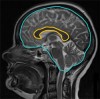 corpus callosum