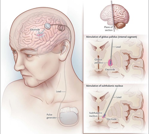 Diagram of electrode implantation in DBS for Parkinson’s disease. The lead is placed through the top of the brain into the target nuclei. It’s attached to a wire that runs to a pulse generator in the chest. Credit: Okun 2012, <em>N. Engl. J. Med</em>. 367:16.