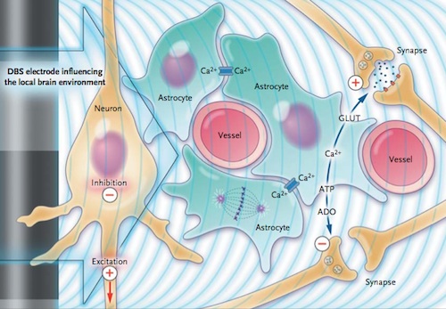 A proposed mechanism of action in DBS. The electrical current inhibits cell bodies and excites axons. It also promotes astrocytes to release Ca<sup>2+</sup>, which leads to the release of glutamate and adenosine.