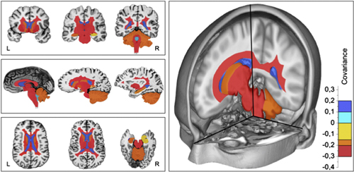 Colored image of the MRI scans of OCB-positive patients. The blue colors represent a higher value of covariance in the OPLS analysis (above zero), and the yellow and red colors represent a lower value of covariance (below zero). Reprinted from <em>J. Neuroimmunol.</em>, Ferreira <em>et al</em>. http://dx.doi.org/10.1016/j.jneuroim.2014.06.010 Copyright 2014, with permission from Elsevier.