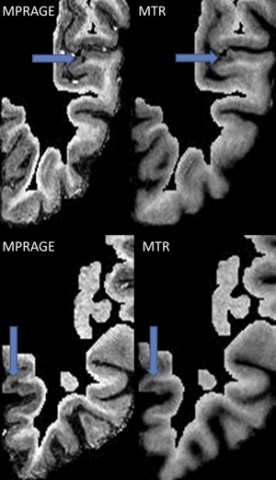 Two examples of cortical lesions in 7-tesla imaging, using magnetization-prepared rapid acquisition gradient echo (MPRAGE) on the left and magnetization transfer ratio (MTR) on the right.