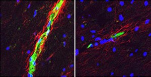 Postmortem cerebellar tissue samples show greater sphingosine-1-phosphate receptor 2 expression (red) in a woman with MS (left) than in a man (right). Image courtesy of Washington University School of Medicine.