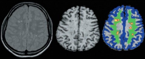 Transverse proton-density-weighted MR image of a multiple sclerosis patient (left), the corresponding MTR image (center), and the segmented image used for the automatic analysis of the MT data (right). The segmented WM lesions are yellow, perilesions are red, white matter nonadjacent to demyelinating lesions is green, and cortical gray matter is blue. From De Stefano <em>et al</em>., <em>Brain</em> (2006) 129 (8): 2008-2016.