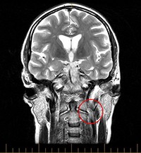 MRI image of a patient with CCSVI showing obliteration of the smaller left internal jugular vein in front of the first and second cervical vertebrae.