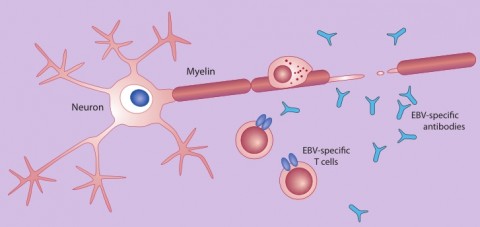 Fig. 2. Mistaken identity. In multiple sclerosis, immune cells attack the myelin sheath that surrounds nerve cells. Hypotheses to explain the assault vary, and some involve EBV. One idea is that T cells or antibodies that recognize EBV might mistake myelin proteins for EBV, in a process called molecular mimicry.